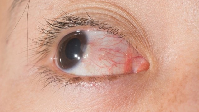 Cách chữa mộng mắt tại nhà đơn giản, dễ thực hiện