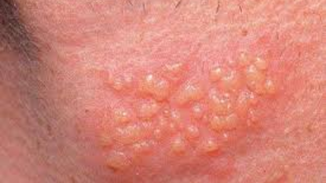 Cách chữa nổi mụn ở bao quy đầu an toàn và hiệu quả