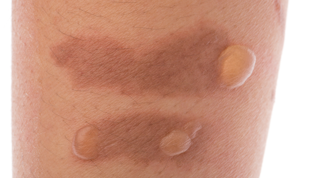 Cách chữa vết bỏng bị phồng rộp da nhanh khỏi