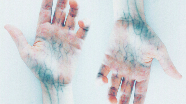 Cách điều trị giãn tĩnh mạch hiệu quả giúp giảm đau, cải thiện tuần hoàn và ngăn biến chứng