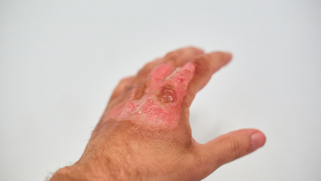 Cách làm giảm đau rát khi bị bỏng hiệu quả