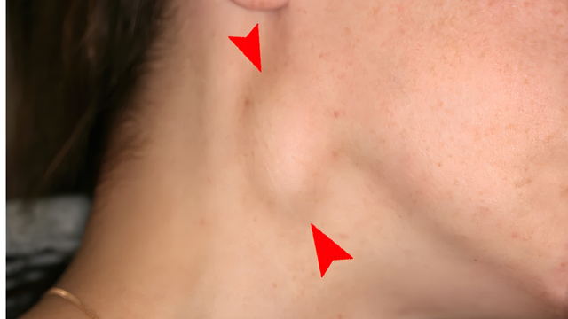 Cách nhận biết sưng hạch bạch huyết là gì? Phương pháp chẩn đoán và điều trị