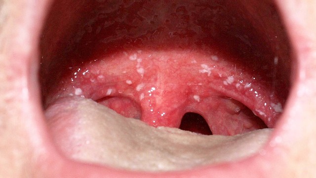 Cách trị bệnh nấm lưỡi ở người lớn an toàn và hiệu quả
