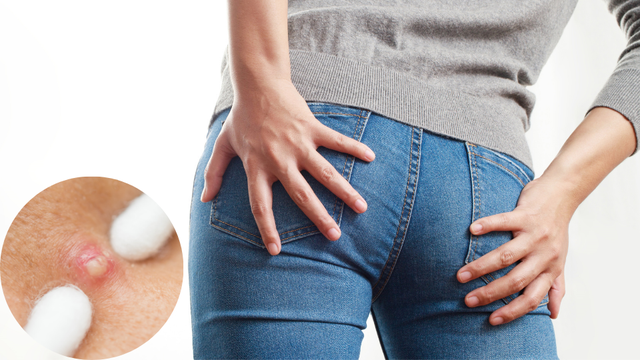 Cách trị mụn nhọt ở hậu môn an toàn và hiệu quả bạn nên biết