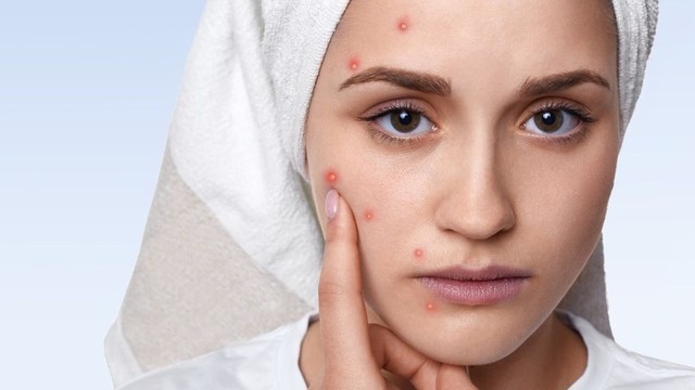 Cách trị mụn nội tiết​ hiệu quả và an toàn