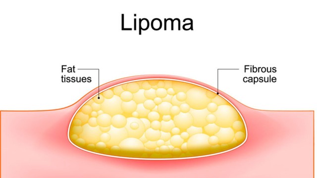 Cách trị mụn u mỡ hiệu quả và an toàn: Giải pháp từ chuyên gia da liễu