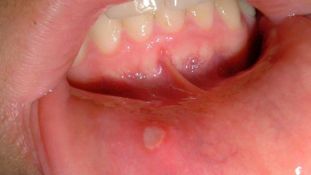 Có cách trị nhiệt miệng trong 1 ngày không? Các biện pháp phòng ngừa