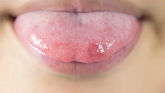 Cắn vào lưỡi là do đâu? Mức độ nguy hiểm và cách khắc phục