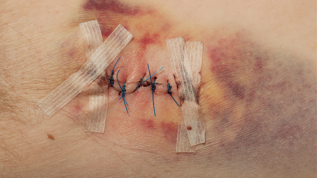 Cắt chỉ vết thương còn sót có nguy hiểm không?