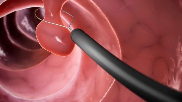 Cắt polyp trực tràng​: Quy trình thực hiện và cách vệ sinh sau khi cắt