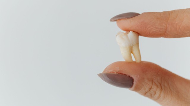 Chân răng khôn là gì? Răng khôn có mấy chân?