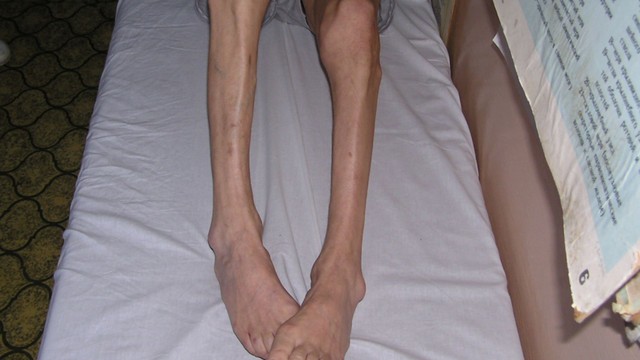 Chân vòng kiềng có chữa được không? Các phương pháp điều trị