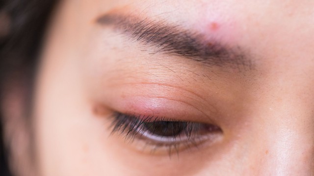 Chắp mắt để lâu có sao không? Cách điều trị chắp mắt