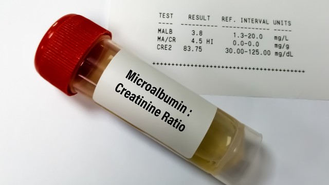 Chỉ số albumin trong nước tiểu cao: Dấu hiệu sớm cảnh báo bệnh thận 