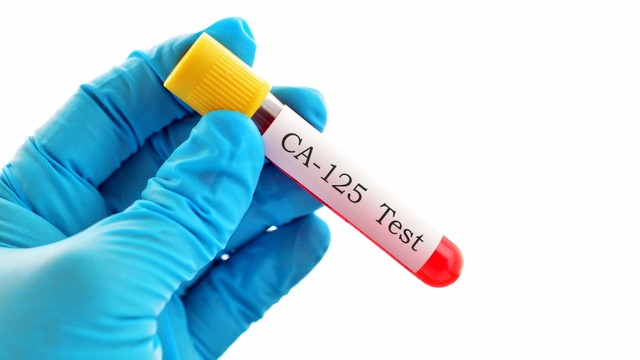 Chỉ số CA 125 là gì? Khi nào cần làm xét nghiệm CA 125?