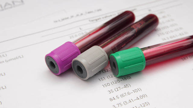 Chỉ số CA 72 - 4 là gì? Vai trò của xét nghiệm CA 72 - 4