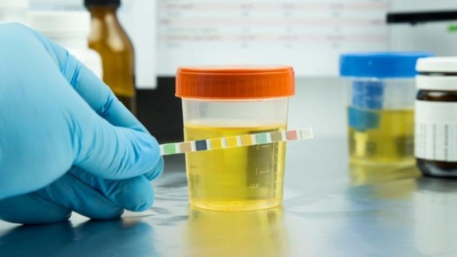 Chỉ số ERY trong nước tiểu 50 có sao không? Ý nghĩa và cảnh báo sức khỏe