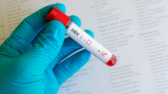 Chỉ số HBV-DNA bao nhiêu là bình thường? Ngưỡng nguy cơ cần biết