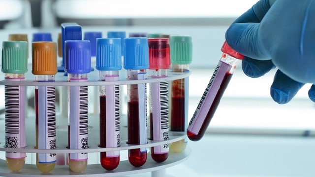 Chỉ số HGB trong máu cao có sao không và cách cải thiện?