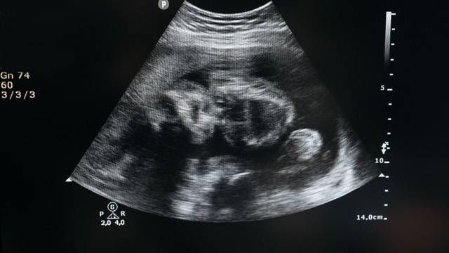 Chỉ số nước ối theo tuần thai: Ý nghĩa, bảng tiêu chuẩn và cách duy trì ổn định