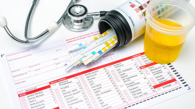 Chỉ số SG trong nước tiểu thấp có ý nghĩa gì? Khi nào nên xét nghiệm chỉ số SG?