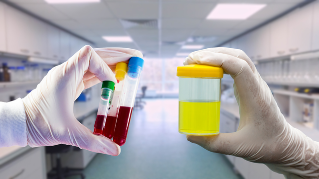 Chỉ số ure và creatinin là gì? Trường hợp nào cần xét nghiệm ure và creatinin