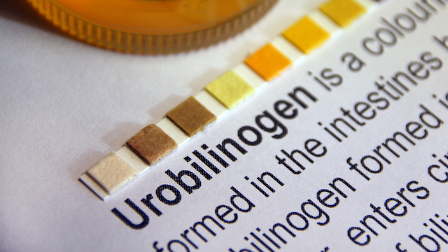 Chỉ số Uro trong nước tiểu là gì? Lưu ý khi thực hiện xét nghiệm nước tiểu
