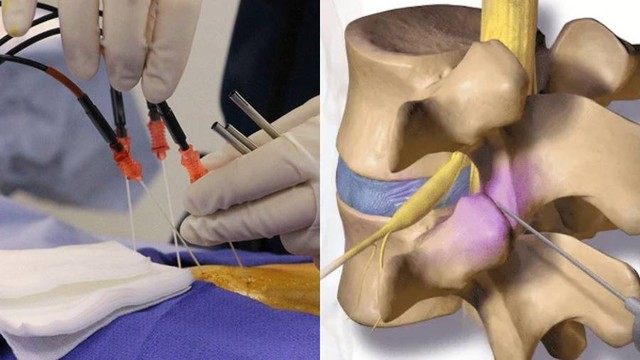 Chữa thoát vị đĩa đệm bằng sóng cao tần có tốt không?