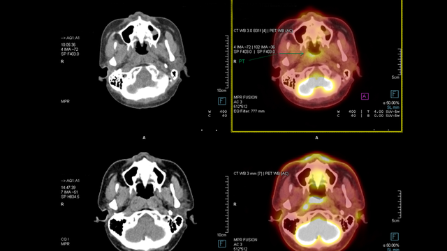 Chụp CT đầu bao nhiêu tiền? Bảng giá tham khảo và quyền lợi bảo hiểm y tế