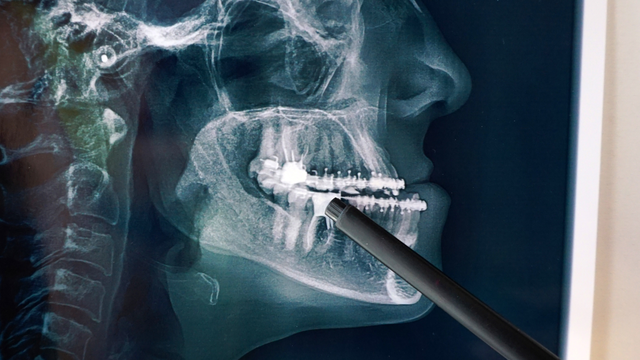 Chụp CT răng phát hiện được những bệnh gì? Khi nào cần thực hiện?