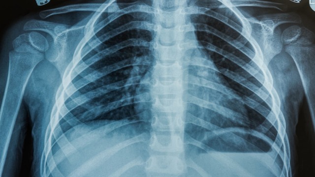 Chụp X-quang bao nhiêu tiền? Những yếu tố ảnh hưởng đến chi phí