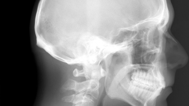 Chụp X-quang đầu: Khi nào cần thực hiện và những thông tin cần biết