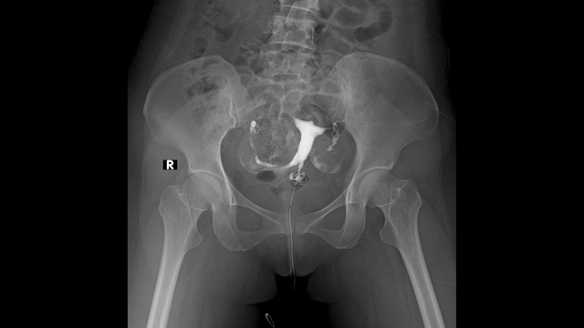 Chụp X-quang tử cung vòi trứng là gì? Khi nào nên thực hiện?