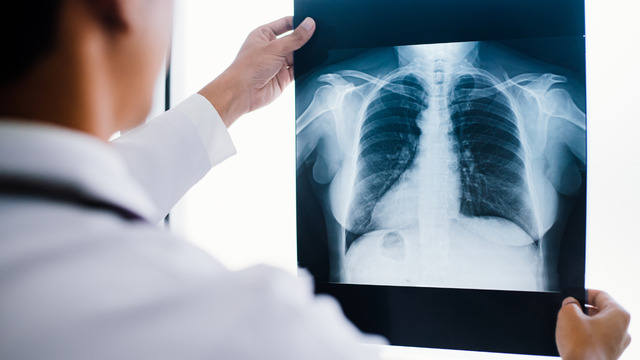 Chụp X-quang phổi phát hiện bệnh gì? Lưu ý khi chụp X-quang phổi