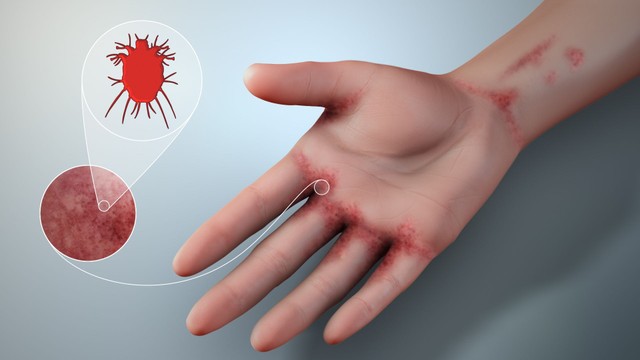 Con cái ghẻ chết ở nhiệt độ bao nhiêu? Cách diệt con cái ghẻ tại nhà hiệu quả
