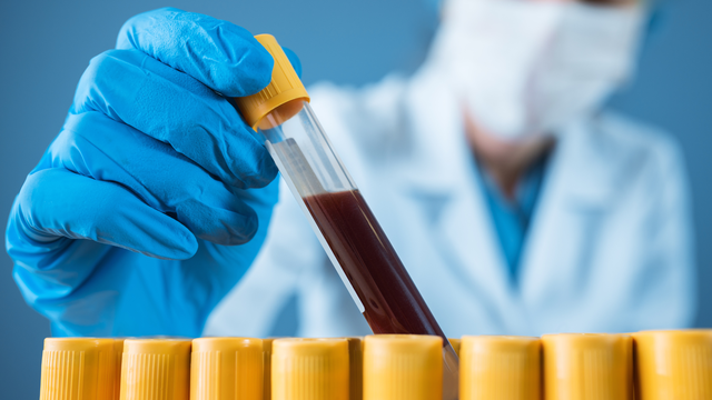 Công thức bạch cầu là gì? Ý nghĩa và cách đọc kết quả xét nghiệm