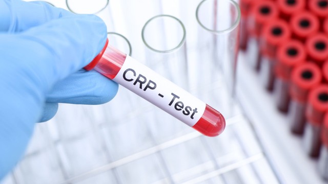 CRP là gì? Ý nghĩa và vai trò của xét nghiệm CRP trong chẩn đoán viêm