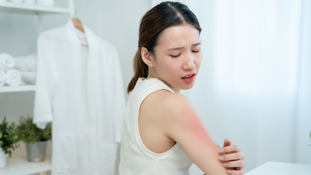Da bị nổi mẩn đỏ ngứa như muỗi đốt​ là do đâu? Có nguy hiểm không?