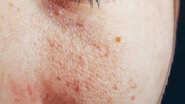 Da khô thiếu chất gì? Cách khắc phục hiệu quả khô da do thiếu chất 