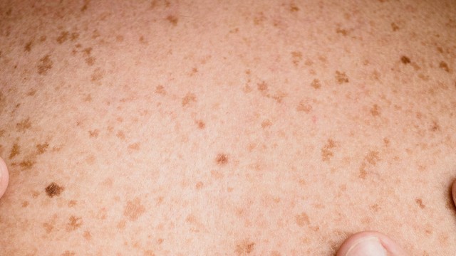 Da nổi đốm nâu không ngứa do đâu? Cách cải thiện sắc tố hiệu quả