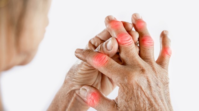 Dấu hiệu bệnh gút ở tay: Nhận biết sớm để tránh biến chứng nguy hiểm