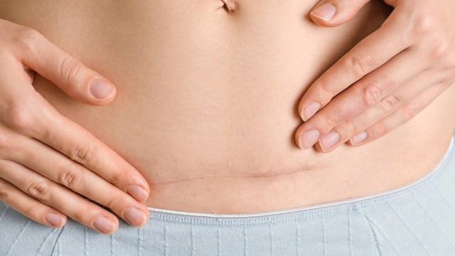 Dấu hiệu có kinh sau sinh mổ là gì? Nhận biết và những điều mẹ cần lưu ý