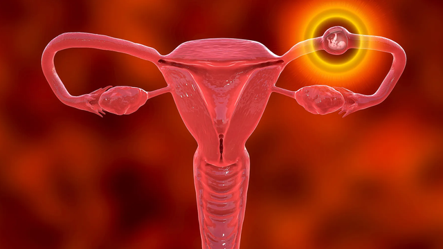 Dấu hiệu thai ngoài tử cung tự tiêu và những điều cần biết