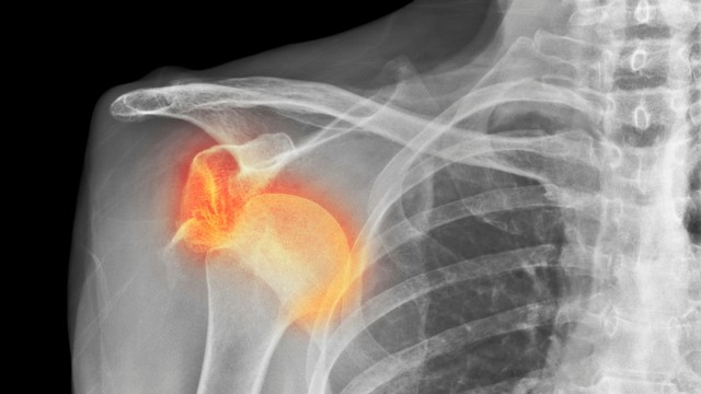 Dấu hiệu trật khớp vai: Nhận biết sớm để điều trị kịp thời