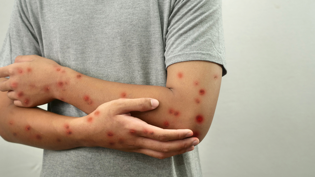 Đậu mùa khỉ có lây không? Bệnh đậu mùa khỉ lây qua đường nào?