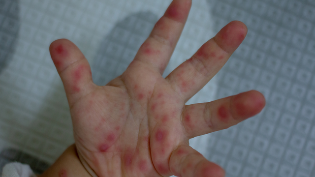 Dịch tay chân miệng đang “nóng” trở lại với tốc độ đáng lo