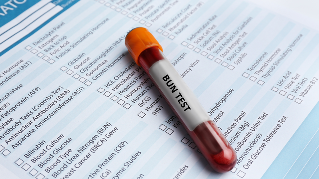 Định lượng ure máu​ là gì? Những trường hợp nào ure máu thay đổi?