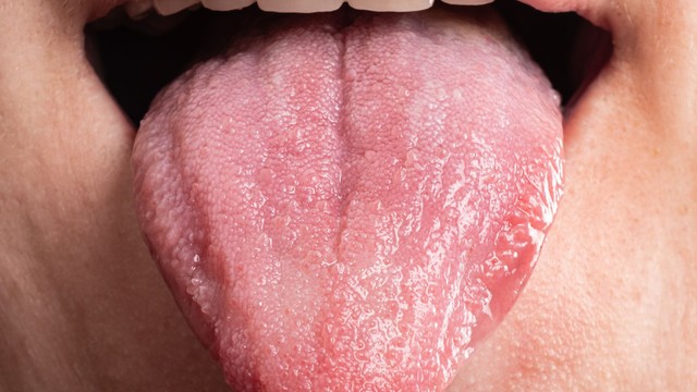 Đốm đỏ trên lưỡi: Nguyên nhân, dấu hiệu cảnh báo và cách chăm sóc an toàn