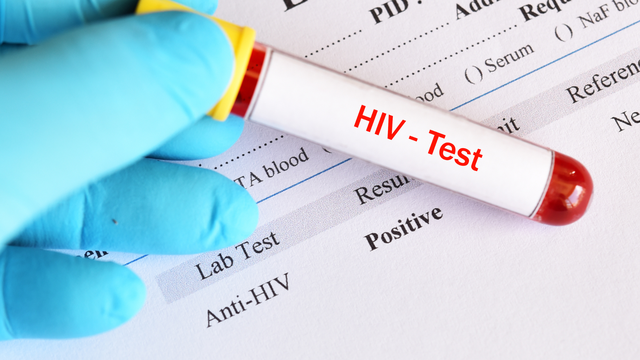 Dương tính giả HIV là gì? Nguyên nhân gây ra kết quả dương tính giả