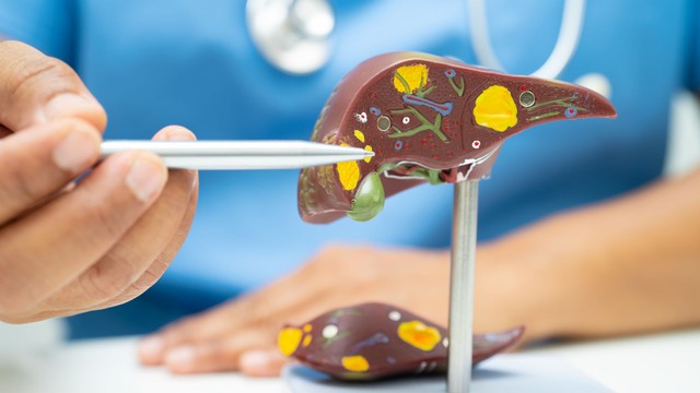 Gan nhiễm mỡ có mấy cấp độ? Triệu chứng và cách phòng ngừa hiệu quả